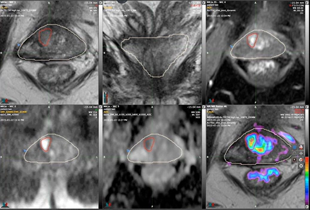 Multiparametric MRI View 3