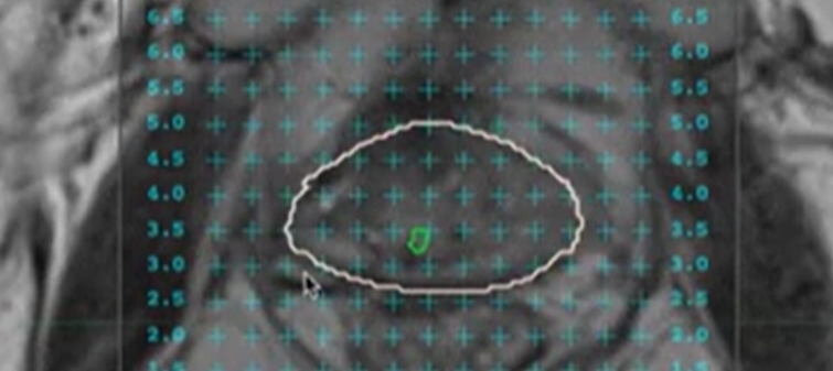 MRI targets fused to virtual ultrasound view