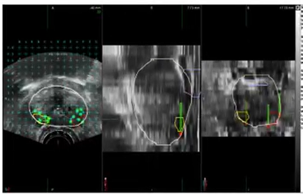 Ultrasound Fusion View 1