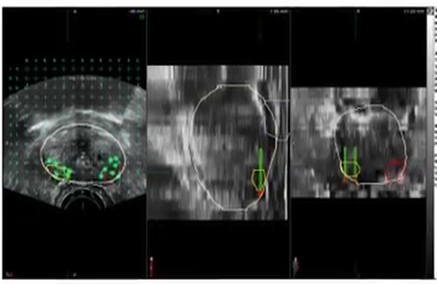 Ultrasound Fusion View 2