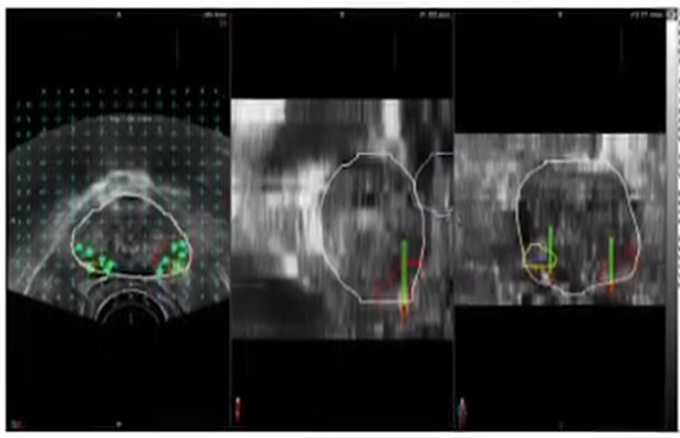 Ultrasound Fusion View 3